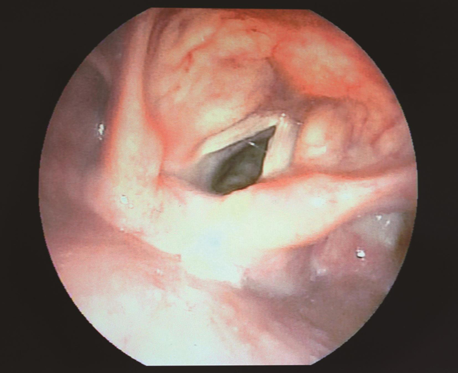 /uploads/image/2025-05-26/161347234图5 喉镜示右侧声带固定于旁正中位.jpg 图5 喉镜示右侧声带固定于旁正中位